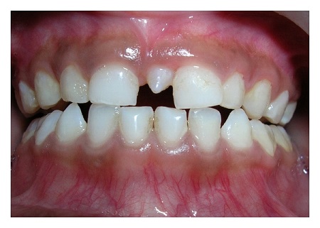 علت رشد دندان اضافه در کودکان, اختلالات مربوط به دهان و دندان, انواع دندان های اضافی