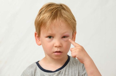 علل اصلی تورم چشم در کودکان