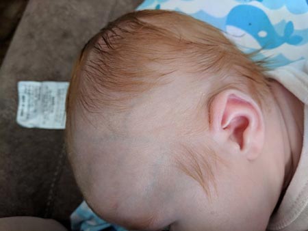 ریزش موی نوزادان,علت ریزش موی سر نوزاد,درمان ریزش مو سر نوزاد