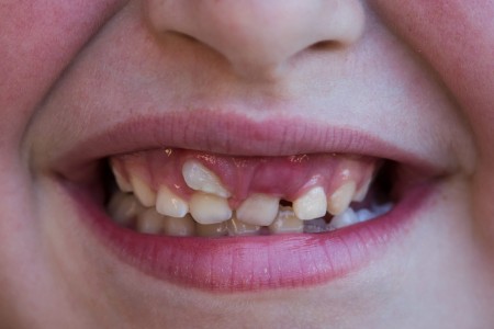 افتادن دندان‌ شیری کودکان, علت دیر افتادن دندان‌ شیری کودکان, دلیل دیر افتادن دندان‌ شیری کودکان