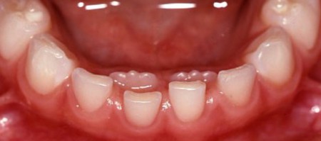 افتادن دندان‌ شیری کودکان, علت دیر افتادن دندان‌ شیری کودکان,دیر افتادن یا نیفتادن دندان شیری در کودکان