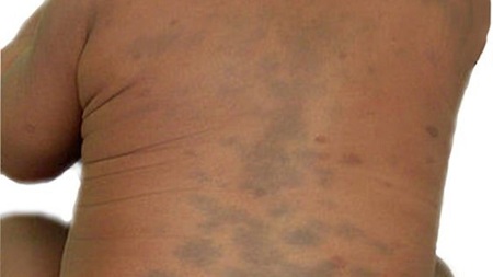 لیزر پوست برای درمان لکه های مغولی نوزادان, علت کبودی بدن نوزاد, نشانه های لکه مغولی در نوزادان