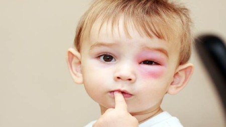 سلولیت چشمی در کودکان چیست,سلولیت چشمی در کودکان ,علل سلولیت چشمی در کودکان