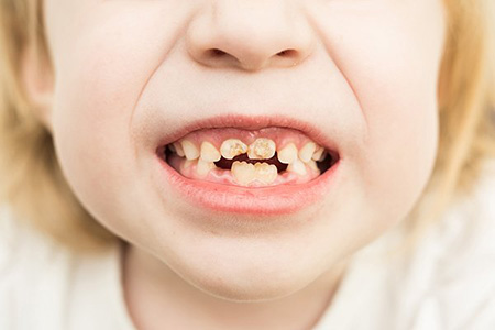 پوسیدگی دندان کودکان ناشی از شیشه شیر, آسیب های شیشه شیر برای دندان ها, علل پوسیدگی دندان ها در کودکان