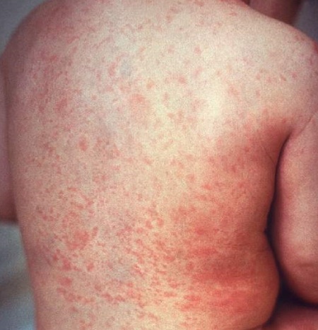 دانه های قرمز بعد از تب