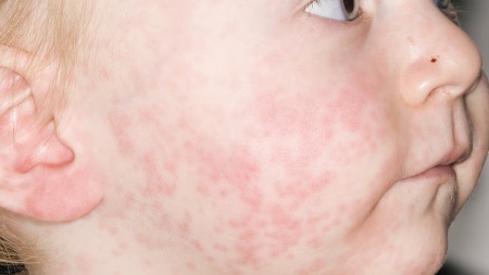 علت تب و جوش در کودکان