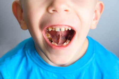 عوارض مصرف نوشابه بر دندان ها, خوردن نوشابه در کودکان, ضرر نوشابه برای معده کودکان
