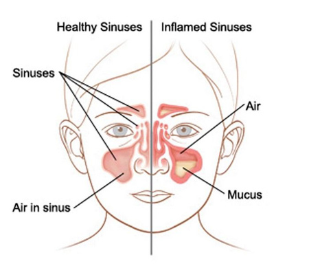 علائم سینوزیت در کودکان,انواع سینوزیت در کودکان,سینوس چیست