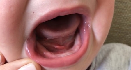 چسبندگی زبان در کودکان, علل چسبیدن زبان به دهان, چسبندگی زبان نوزاد