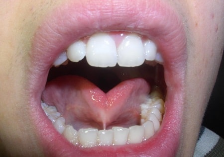 درمان چسبیدن زبان به کف دهان, علایم چسبیدن زبان به کف دهان, چسبیدن زبان به کف دهان