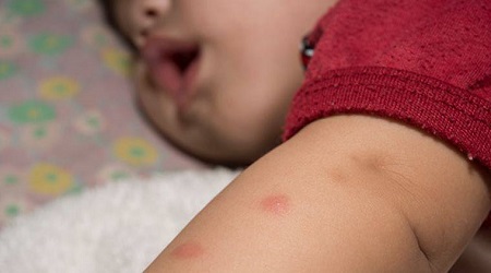 درمان جای نیش پشه, تسکین درد نیش پشه در کودکان, درمان نیش پشه در کودکان
