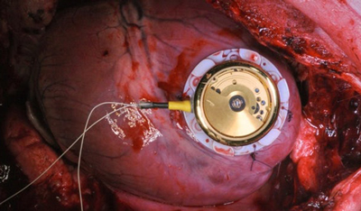 عمل جراحی گذاشتن باتری قلب, تعداد ضربان قلب