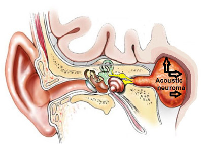 تشخیص نوروم آکوستیک, علایم تومور عصبی شنوایی