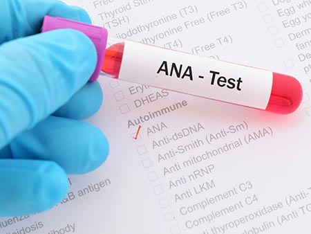 آزمایش ana, تحلیل آزمایش خون  ANA, ana در آزمایش خون چیست