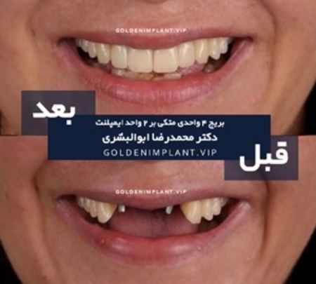 نمونه کار بهترین مرکز ایمپلنت در شمال تهران