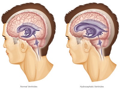 روش شنت گذاری در هیدروسفالی, علل هیدروسفالی