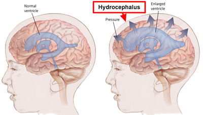 روش شنت گذاری در هیدروسفالی, علل هیدروسفالی