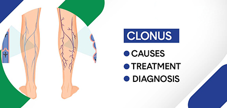 کلونوس, علت کلونوس, نشانه های بیماری کلونوس