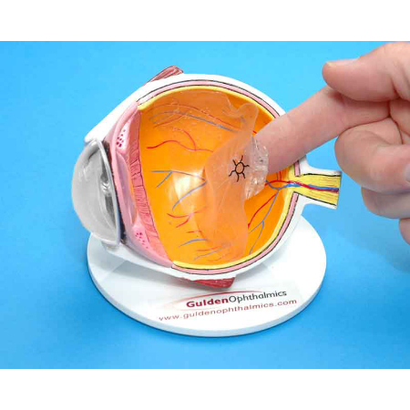 معاینه با مردمک گشاد شده بهترین روش تشخیص جداشدگی زجاجیه خلفی است جداشدگی زجاجیه خلفی, تشخیص جداشدگی زجاجیه