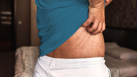 کاهش استروژن در یائسگی خشکی و خارش پوست شکم را به دنبال دارد خارش شکم, خارش پوست بدن و شکم