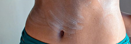 کرم هیدروکورتیزون یک درصد برای خارش خفیف مؤثر است خارش شکم, خارش پوست بدن و شکم