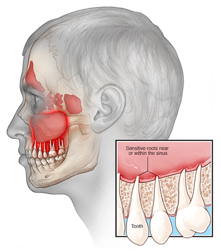 درد استخوان گونه, درد دندان و گونه