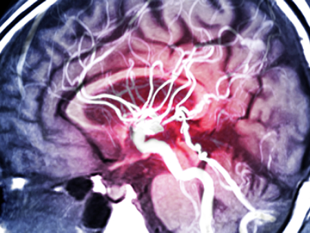 آنژیوگرافی مغزی چیست, آنژیوگرافی مغز