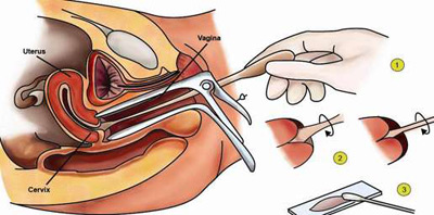 درمان زخم دهانه ی رحم,چگونگی درمان زخم دهانه ی رحم رحم,تست پاپ اسمیر