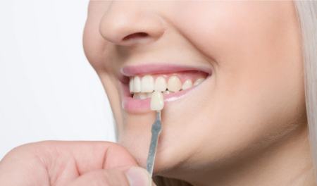 کامپوزیت دندان کامپوزیت دندان