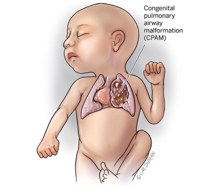 برخی ناهنجاریهای مادرزادی ریه ممکن است بدون علامت باشند ناهنجاری مادرزادی ریه, ناهنجاری مادرزادی ریه در بزرگسالان
