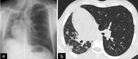تشخیص اغلب در سونوگرافی پیش از تولد انجام میشود ناهنجاری مادرزادی ریه, ناهنجاری مادرزادی ریه در بزرگسالان
