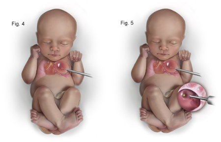 ناهنجاریهای ریه ممکن است با مشکلات قلبی همراه باشند ناهنجاری مادرزادی ریه, ناهنجاری مادرزادی ریه در بزرگسالان