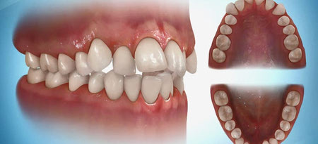 کراودینگ دندانها, لمینت دندان های نامرتب, کشیدن دندان برای حل مشکل کراودینگ