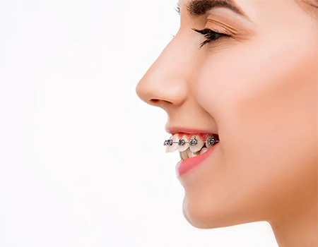 دیپ بایت, درمان دیپ بایت دندان, دیپ بایت به عنوان اپن بایت قدامی نیز شناخته می شود