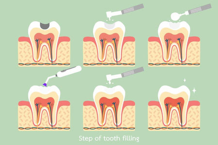 معایب پرکردن دندان با کامپوزیت, پر كردن فاصله دندان با كامپوزيت, مراقبت بعد از پر كردن دندان با كامپوزيت