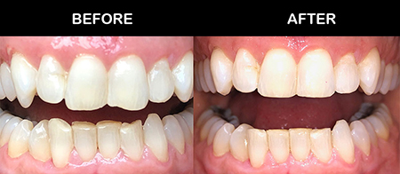 کانتور دندان, تراش مینای دندان, کاربرد کانتورینگ دندان
