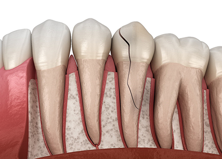 عوارض شقاق دندان, پیشگیری از شقاق دندان, ترک خوردگی دندان