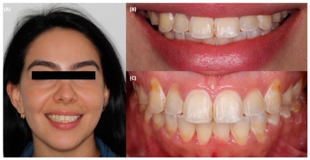 لمینت کریستالی دندان, مراحل انجام لمینت کریستالی دندان, لبخند زیبا با لمینت کریستالی دندان