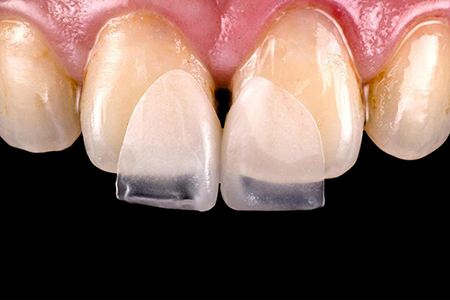 لمینت کریستالی دندان, مراحل انجام لمینت کریستالی دندان, مراقبت بعد از انجام لمینت کریستالی دندان