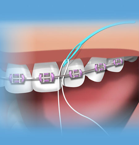 نخ دندان کشیدن حین ارتودنسی, طریقه نخ دندان کشیدن در ارتودنسی