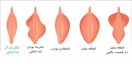 انواع مختلف واژن