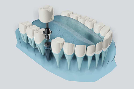 عوارض ایمپلنت دیجیتال دندان, ایمپلنت دندان با تکنیک دیجیتال, عوارض ایمپلنت دیجیتال