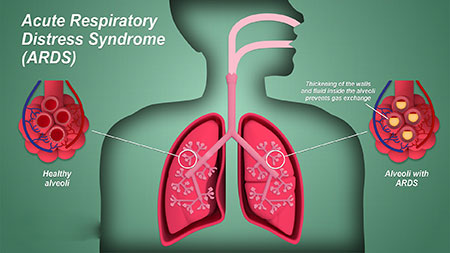 سندرم دیسترس تنفسی نوزادان , سندروم زجر تنفسی حاد