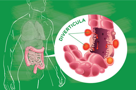 علائم دیورتیکولیت, دیورتیکولیت چیست