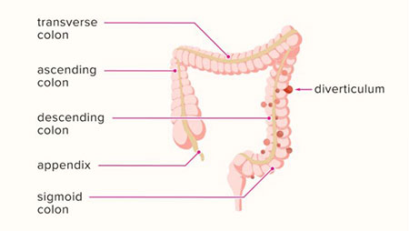 علائم دیورتیکولیت, دیورتیکولیت چیست