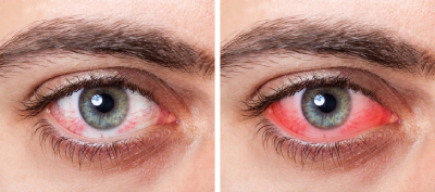  داروی درمان خشکی چشم, خشکی چشم درطب سنتی