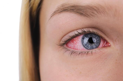 خشکی چشم و درمان آن, علت خشکی چشم