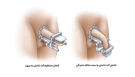 کجی آلت تناسلی در مردان