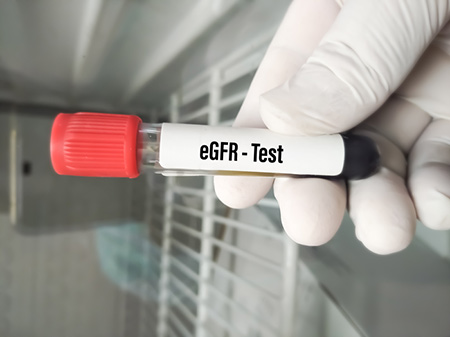 آزمایش egfr