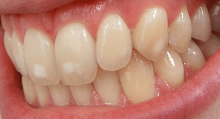 مراقبت از مینای دندان, جلوگیری از هیپوپلازی مینا, علل هیپوپلازی مینای دندان